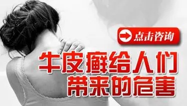 牛皮癣除了损害皮肤还会怎样